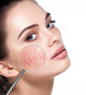 Facial Vein Removal