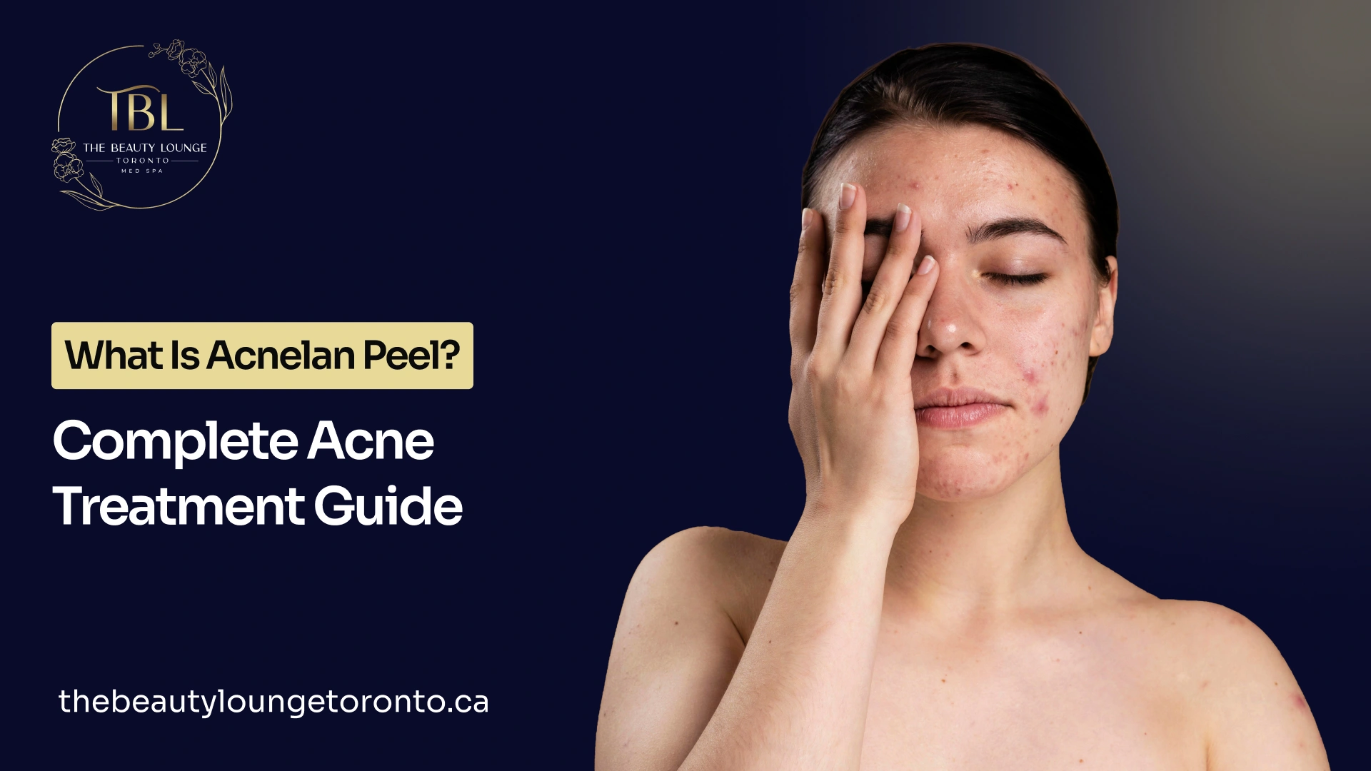 Guide on acnelan peel for acne and skin care treatment.
