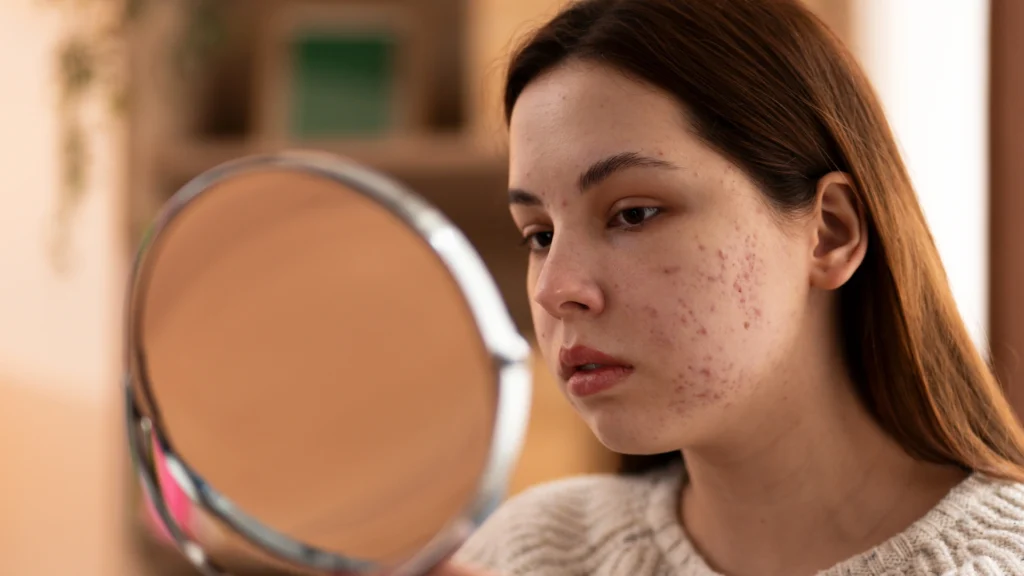 Acnelan peel procedure for acne-prone skin treatment.
