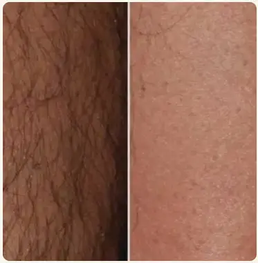 Toronto hair removal laser before and after treatment information.